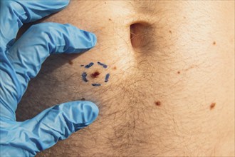 Doctor in medical gloves paint lines around male birthmarks. Preparing procedure for medical