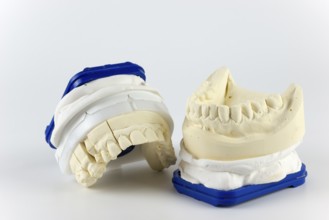 Two dental plaster casts with a blue border on a white background, representing the upper and lower