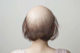 Back view of woman with medical condition called Alopecia cuasing balding and hair loss. KI