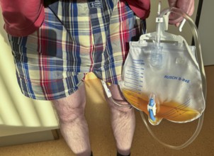 Man in hospital, after urological surgery, with urine bag on a urinary catheter