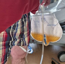 Man in hospital, after urological surgery, with urine bag on a urinary catheter