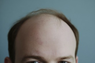 Close up of balding forehead of a middle aged man in front of blue background. Generative AI, AI