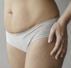 Close up woman body with stretch marks. Resolution and high quality beautiful photo