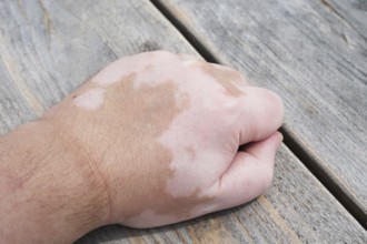 male hand with vitiligo skin condition, characterized by white unpigmented patches or blotches