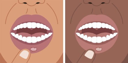 Vector illustration canker sore, aphthous ulcer on the lip, stomatitis