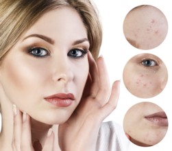 Portrait of young woman and circles shows problem skin
