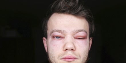 A person with a swollen eye partially closed in moderate lighting allergic reaction on the lip