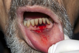 Symbolic image for periodontitis, heavily bleeding gums