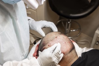 Doctor performing hair transplant. Surgeons in the operating room carry out hair transplant surgery