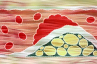 Arteriosclerosis is a common vascular disease in which the arteries become narrowed and hardened by