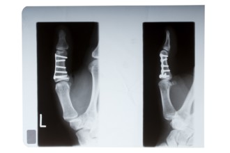 Thumb bone nailed in X-ray image