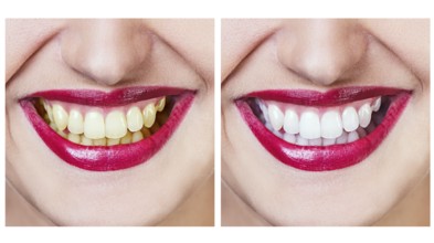 Whitening - bleaching treatment, before and after, woman teeth and smile isolated on white