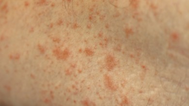 Close up to patches of inflammation called milk rash or atopic dermatitis on an adult caucasian