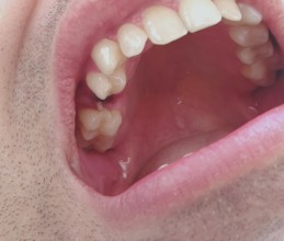 Open mouth of a man with the place of a pulled out small molar tooth, healing of a wound in the