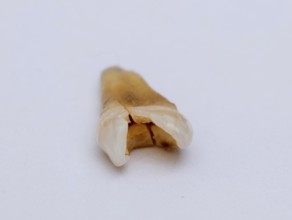 Pulled out, cracked and damaged, tooth, second premolar on a white background, Karaganda,