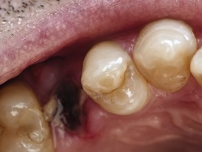 Open mouth of a man with the place of a pulled out small molar tooth, healing of a wound in the