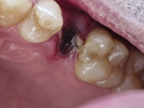 Open mouth of a man with the place of a pulled out small molar tooth, healing of a wound in the