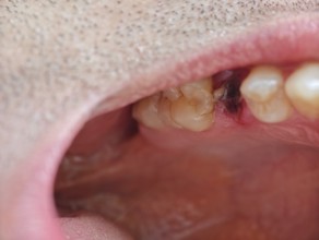 Open mouth of a man with the place of a pulled out small molar tooth, healing of a wound in the