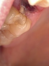Open mouth of a man with the place of a pulled out small molar tooth, healing of a wound in the