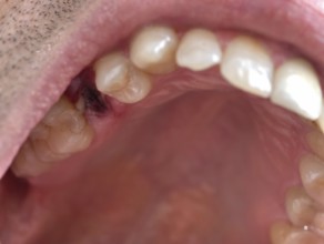 Open mouth of a man with the place of a pulled out small molar tooth, healing of a wound in the