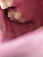 Open mouth of a man with the place of a pulled out small molar tooth, healing of a wound in the
