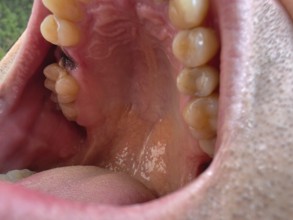 Open mouth of a man with the place of a pulled out small molar tooth, healing of a wound in the