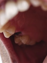 Open mouth of a man with the place of a pulled out small molar tooth, healing of a wound in the