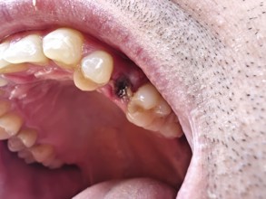 Open mouth of a man with the place of a pulled out small molar tooth, healing of a wound in the