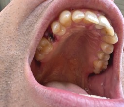 Open mouth of a man with the place of a pulled out small molar tooth, healing of a wound in the