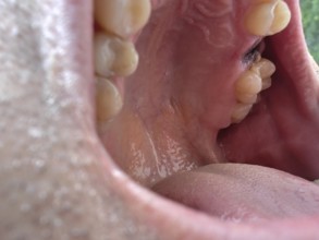Open mouth of a man with the place of a pulled out small molar tooth, healing of a wound in the