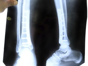 X-ray of the leg. Atyrau, Kazakhstan