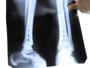 X-ray of the leg. Krasnodar, Russia