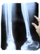 X-ray of the leg. A steel plate holding together the tibia of the leg. Krasnodar, Russia