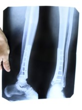 X-ray of the leg. Krasnodar, Russia