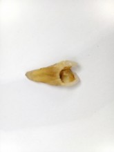 Pulled out, cracked, and damaged tooth, second premolar on a white background, Karaganda,