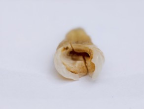 Pulled out, cracked, and damaged tooth, second premolar on a white background, Karaganda,