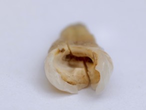 Pulled out, cracked, and damaged tooth, second premolar on a white background, Karaganda,