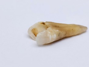 Pulled out, cracked and damaged, tooth, second premolar on a white background. Karaganda,