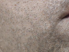 The skin of the man's face with stubble and flaky skin, sparse, gray hairs in the beard. Karaganda,
