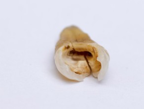 Pulled out, cracked and damaged, tooth, second premolar on a white background, Karaganda,
