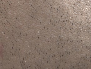 The skin of man's face with stubble and flaky skin, sparse gray hairs in the beard, Karaganda,