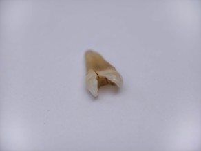 Pulled out, cracked and damaged tooth, second premolar on a white background. Karaganda, Kazakhstan