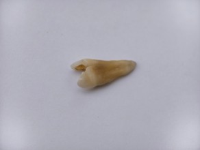 Pulled out, cracked and damaged tooth, second premolar on a white background, Karaganda, Kazakhstan