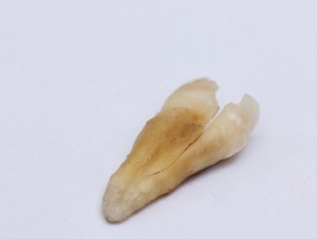 Pulled out cracked and damaged tooth, second premolar on a white background. Karaganda, Kazakhstan