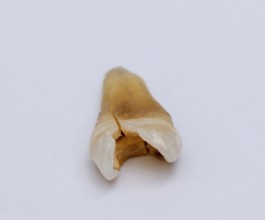 Pulled out cracked and damaged tooth, second premolar on a white background. Karaganda, Kazakhstan