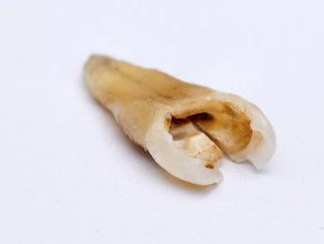Pulled out, cracked and damaged, tooth, second premolar on a white background. Karaganda,