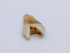 Pulled out, cracked and damaged, tooth, second premolar on a white background. Karaganda,