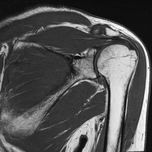 Black and white MRI of a shoulder showing the structure of bone and surrounding tissue