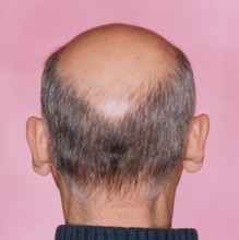 Close-up of the back of a man's head with a distinct bald head or hair loss