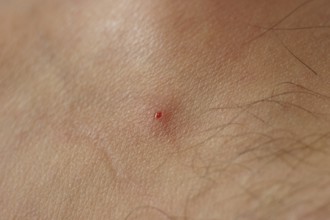 Black fly bite, skin, people, São Paulo, Brazil